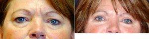 Dr Catherine Winslow, MD, Indianapolis Facial Plastic Surgeon - Upper Lower Eyelift Blepharoplasty