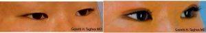 Dr Goretti Ho Taghva, MD, Mission Viejo Plastic Surgeon - 20 Year Old Woman Treated With Asian Eyelid Surgery