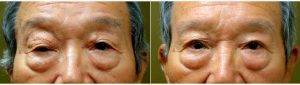 Dr Jeffrey M. Joseph, MD, Newport Beach Oculoplastic Surgeon - 65 Year Old Man Treated With Revision Of Prior Asian Eyelid Surgery