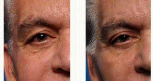 Dr Kian Karimi, MD, FACS, Los Angeles Facial Plastic Surgeon - Upper Eyelid Rejuvenation