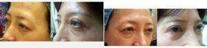 Dr Luis A. Cenedese, MD, FACS, New York Plastic Surgeon - 38 Year Old Woman Treated With Asian Eyelid Surgery