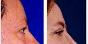 Dr Myriam Loyo, MD, Portland Facial Plastic Surgeon - Side View After Upper And Lower Eyelid Surgery