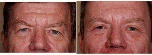 Dr Paul E. Goco, MD, Nashville Facial Plastic Surgeon - Upper And Lower Blepharoplasty And Bilateral Brow Lift