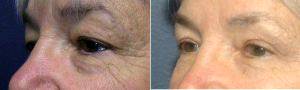 Dr Scott C. Sattler, MD, FACS, Seattle Plastic Surgeon - 65 Year Old Female Treated With Upper Eyelid Lift (blepharoplasty) And Fat Grafting