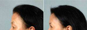 Dr Suzanne Yee, MD, Little Rock Facial Plastic Surgeon - 51 Year Old Woman Treated With Asian Eyelid Surgery