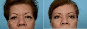 Dr Thomas A. Mustoe, MD, FACS, Chicago Plastic Surgeon - 61 Year Old Woman Treated With Eyelid Surgery (Upper And Lower) And Browlift
