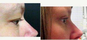 Dr. Ahmed Maki, DO, Los Angeles Facial Plastic Surgeon - A 42 Year Old Woman Treated With Upper Eyelid Surgery