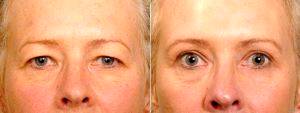 Dr. Bryan Mendelson, FRACS, FACS, Melbourne Plastic Surgeon - 49 Year Old Female Before And One Year After Having A Quality Upper Eyelid Correction.