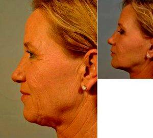 Dr. Burke Robinson, MD, FACS, Atlanta Facial Plastic Surgeon - Upper And Lower Blepharoplasty With A Hetter Peel