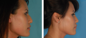 Dr. David W. Kim, MD, Bay Area Facial Plastic Surgeon - Asian Eyelid Surgery Pictures (1)