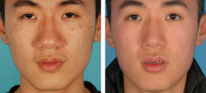Dr. David W. Kim, MD, Bay Area Facial Plastic Surgeon - Asian Eyelid Surgery Pictures (2)