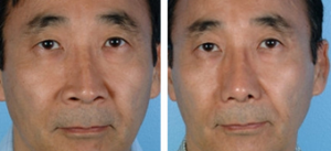 Dr. David W. Kim, MD, Bay Area Facial Plastic Surgeon - Asian Eyelid Surgery Pictures (3)