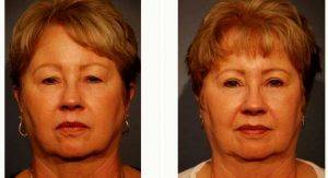 Dr. Harry V. Wright, MD, Sarasota Facial Plastic Surgeon - 70 Year Old Woman Treated With Upper Eyelid Surgery (Blepharoplasty)