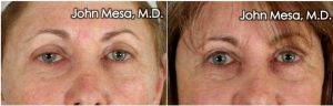 Dr. John Mesa, MD, New York Plastic Surgeon - 52 Year Old Woman Treated With Eyelid Surgery For Sleepy Eyes ( Upper Lid Ptosis Repair Lift)