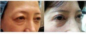 Dr. Luis A. Cenedese, MD, FACS, New York Plastic Surgeon - 41 Year Old Lady For Correction Of Asian Eyelid Surgery