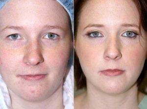 Dr. Michael A. Epstein, MD, FACS, Chicago Plastic Surgeon - 22 Year Old Female Underwent An Upper Eyelid Blepharoplasty