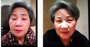 Dr. Paul B. Johnson, MD, Philadelphia Oculoplastic Surgeon - 59 Year Old Woman Treated With Asian Eyelid Surgery