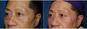 Dr. William Portuese, MD, Seattle Facial Plastic Surgeon - 56 Year Old Man Treated With Asian Eyelid Surgery