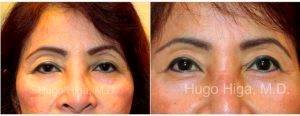 Eyelid Surgery By Dr. Hugo Higa, MD, Honolulu Oculoplastic Surgeon