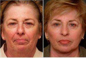 Facelift, Upper And Lower Blepharoplasty Before And After By Doctor Mark Glasgold, MD, Highland Park Facial Plastic Surgeon (1)
