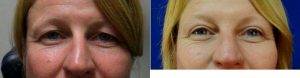 Patient In Her 40s Concerned With Upper Eyelid Appearance And Heavy Sensation By Dr. Jasmine Mohadjer, MD, Tampa Oculoplastic Surgeon
