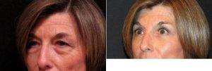 Upper And Lower Blepharoplasty By Dr. Milind K. Ambe, MD, Orange County Plastic Surgeon