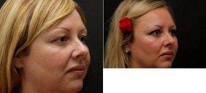 Upper Blepharoplasty With Doctor Todd C. Miller, MD, Newport Beach Facial Plastic Surgeon