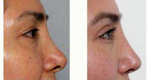 Woman Treated With Upper Eyelid Surgery With Doctor Nima Shemirani, MD, Beverly Hills Facial Plastic Surgeon