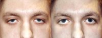 18 year old man treated with Ptosis Surgery