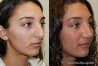 19 year old woman treated with Rhinoplasty - 6 months after surgery