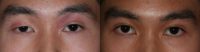 18-24 year old man treated with Double Eyelid Surgery