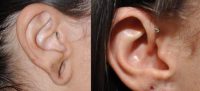 18-24 year old woman treated with Ear Lobe Surgery