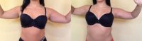 18-24 year old woman treated with Liposculpture