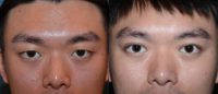 22 year old man treated with Asian Eyelid Surgery
