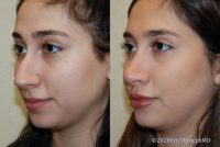 23 year old woman treated with Rhinoplasty - 1 year after surgery