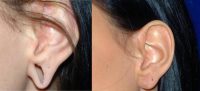 25-34 year old woman treated with Ear Lobe Surgery