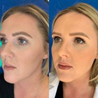 25-34 year old woman treated with Injectable Fillers for Jawline sculpting