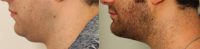 25-34 year old man treated with Chin Liposuction