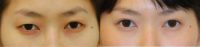 25-34 year old woman treated with Asian Eyelid Surgery