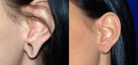 25-34 year old woman treated with Ear Lobe Surgery