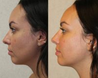 25-34 year old woman treated with Toxin only for Nonsurgical Chin Enhancement / Augmentation