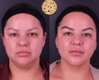 25-34 year old woman treated with FaceTite and Buccal Fat Pad Removal