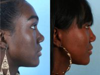 25-34 year old woman treated with African American Rhinoplasty