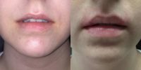 28 years old with a thin asymmetrical upper lip showing her teeth before injection