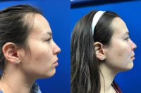 25-34 year old woman treated with Injectable Fillers