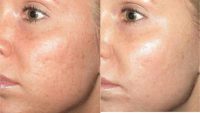 25-34 year old woman treated with Scars Treatment