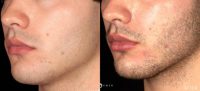 25-34 year old man treated with Restylane Refyne