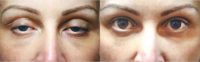 32 year old woman treated with Ptosis Surgery
