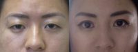 25-34 year old woman treated with Double Eyelid Surgery
