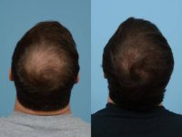 25-34 year old man treated with Hair Transplant
